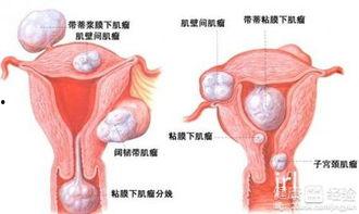 子宫肌瘤吃瓜